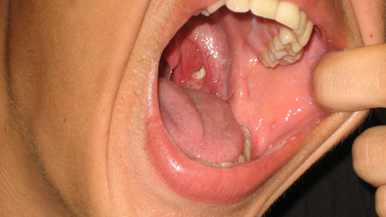 What is tonsillitis, and why does it occur